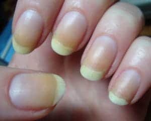 Oorzaken van het gele nagelsyndroom